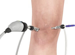 Knee Arthroscopy by Dr. Irfan Masud