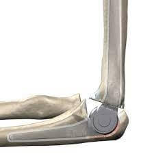 Total-Elbow-Replacement by Dr. Irfan Masud